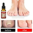 Ingrown Toenail Treatment,Ingrown Toenail Pain Reliever & Softener Kit