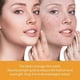 thumbnail image 5 of 5-28pcs Acne Patch Repair Blemish Pimple Remover Tool for Face Chin Forehead Breathable, 5 of 5