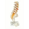 Anatomical model: lumbar spinal column W/ dorso-lateral prolapsed disc
