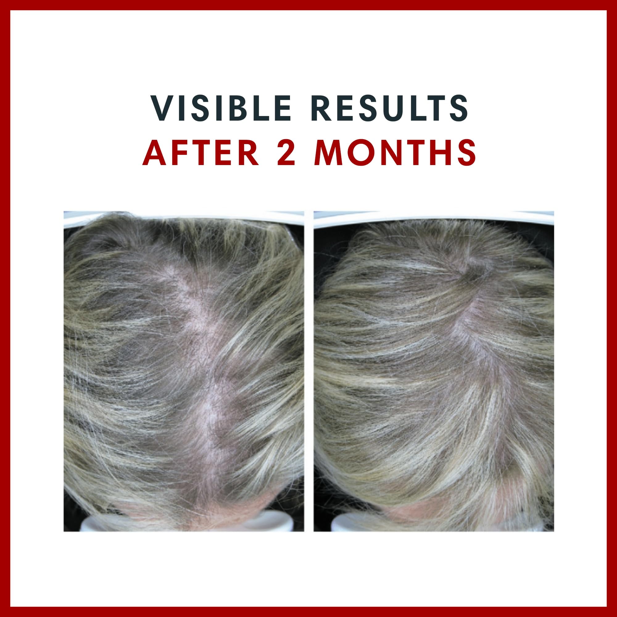 Consult Beaute Biotin GAIN Gummies - Reduce Hair Loss, Clinically Tested - 60 Count