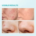 thumbnail image 4 of Crema facial ZealSea con ácido azelaico 10% para aliviar el enrojecimiento, 30 ml, 2 unidades, 4 of 6