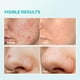 thumbnail image 4 of Crema facial ZealSea con ácido azelaico 10% para aliviar el enrojecimiento, 30 ml, 2 unidades, 4 of 6