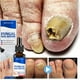 thumbnail image 2 of Aceite para tratamiento de uñas por hongos, esencia para reparación de pies, eliminación de hongos en las uñas de los pies, Gel, crema antiinfección, eliminación de uñas por hongos, 10ML Dengxun unisex, 2 of 2
