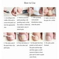 thumbnail image 3 of Dedicated Ingrown Nail Orthodontic Correction Patch Inflammation Manicure Clippers, 3 of 5