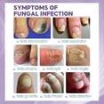 thumbnail image 2 of Jaysuing-nail Repair Spray, Anti-infection, Paronychia, Antifungal Treatment, Feet And Hands Care |, 2 of 3