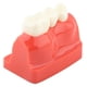 thumbnail image 5 of 1 modelo dental de demostración dental de resina, modelo de kit dental de tres coronas, análisis de implantes desmontable puente de corona dental, para programas de enseñanza dental brillar Electrónica, 5 of 5