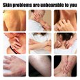 thumbnail image 3 of Pomada Para Psoriasis, Fácil De Absorber, Segura, 3 Unidades Que Reducen El Enrojecimiento Cada 20 G, Pomada Hidratante Para Aliviar La Picazón Y Eczema Para Manos, 3 of 7
