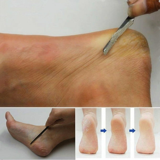 Foot hard skin removal clearance near me