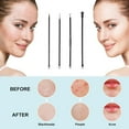 thumbnail image 3 of Blackhead Remover Tool, Blackhead Extractor tool for Face, Extractor Tool for Zit Acne, 3 of 5