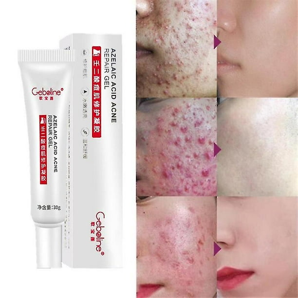 30g Azelaic Acid Gel Gel Acne Cream Removes Acne Gently Brightens Skin 15% Azelaic Acid Ointment zhangyuxiang LED