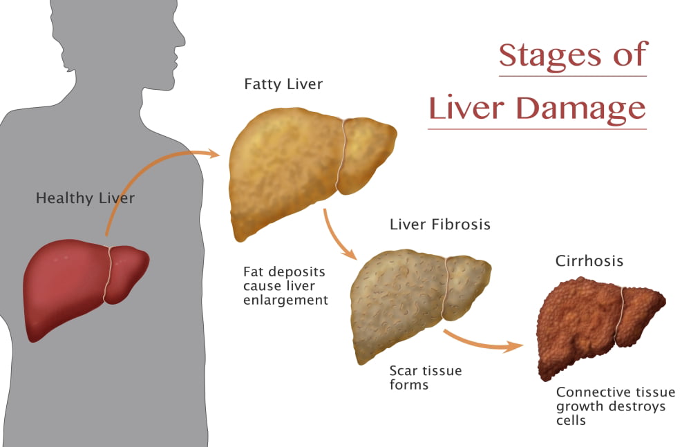 Stages of Liver Damage Stretched Canvas - Monica SchroederScience ...