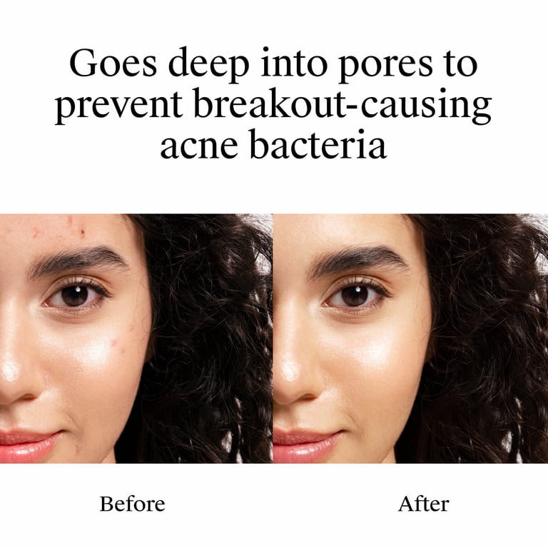 Neutrogena On-The-Spot Acne Treatment, 2.5% Benzoyl Peroxide photo 3