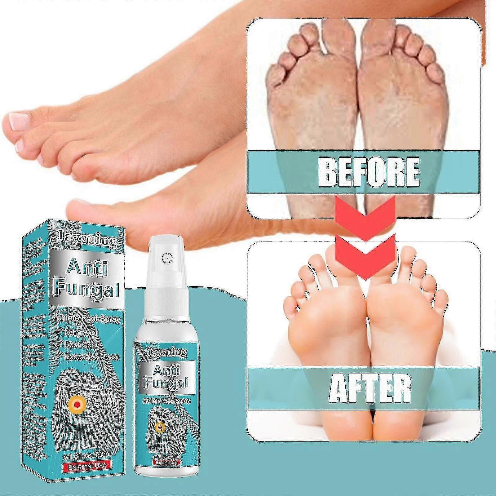 Jaysuing Athletes Foot Deodorant Spray Improve Smelly Sweaty Feet ...