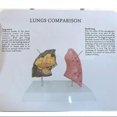 thumbnail image 2 of Smoker'S Lung Model Healthy Lung Model Lung Anatomy Model with Pathological Respiratory System Dise, 2 of 5