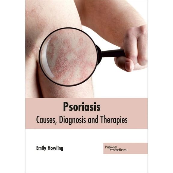 Psoriasis: Causes, Diagnosis and Therapies, (Hardcover)