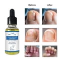 thumbnail image 4 of Nail Fungus Treatment Toenail Repair Essence Renew Damaged Discolored Foot and Toenails for Finger Toenail New, 4 of 4