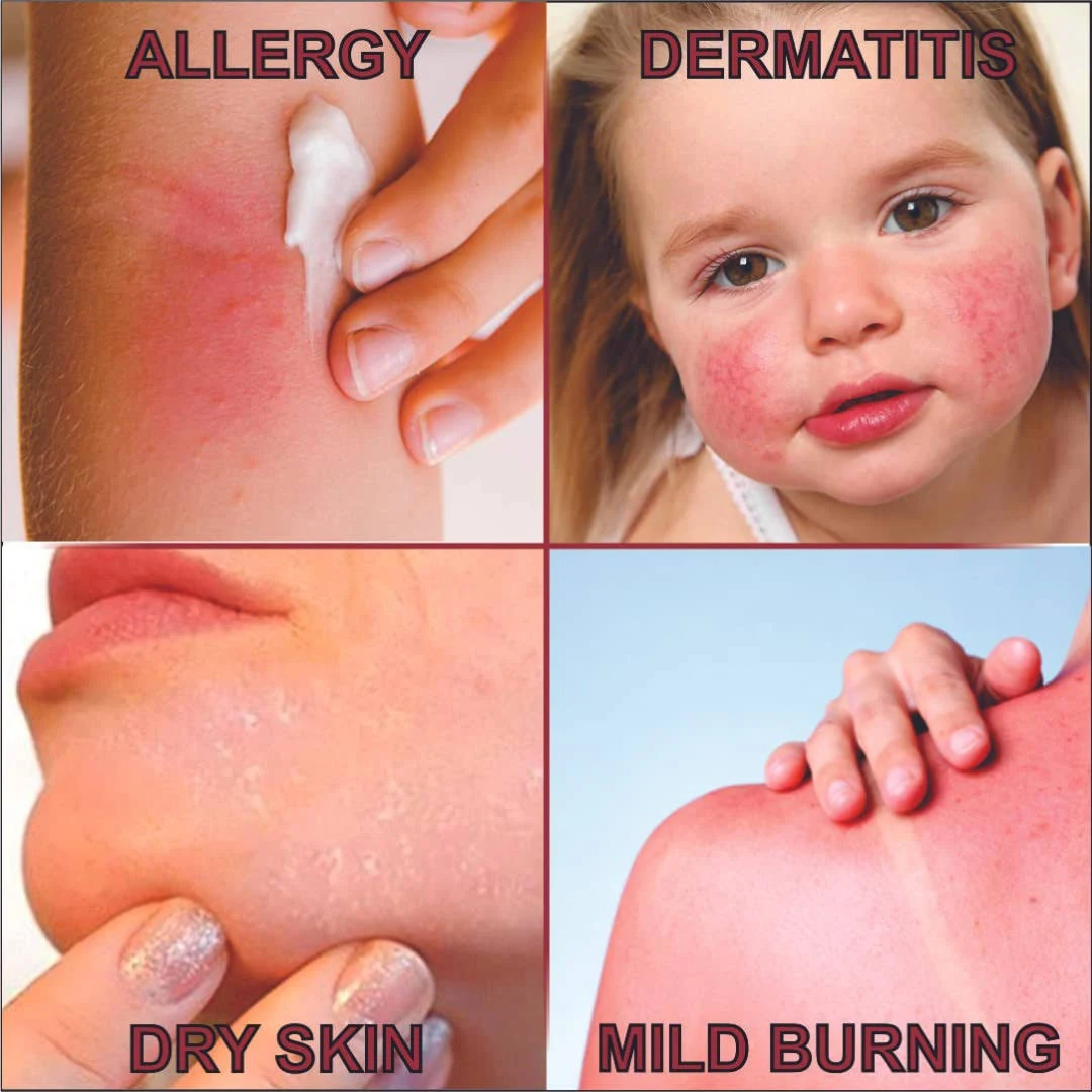 Quatriderm Ointment 2oz – Skin Relief Cream for Redness, Dryness, and Irritated Skin-Unisex Cream