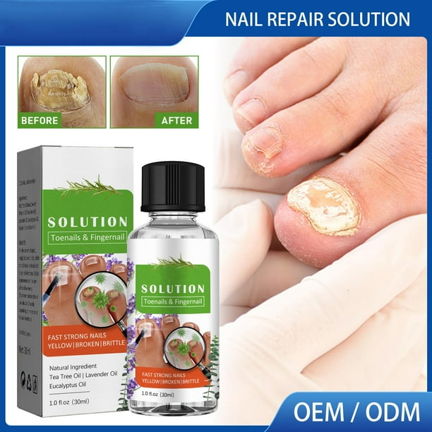 tratamiento de uñas,uña del pie dañada tratamiento de hongos en amarillas,Solución de tratamiento de hongos en de los pies de 30 ml,fórmula líquida amarilla para el Macarena tratamiento de uñas