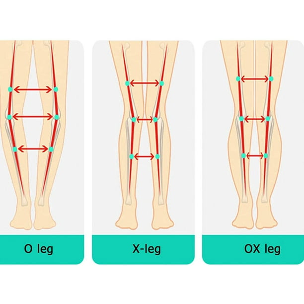 O/X Leg Type Correction Belt,Lightweight Belt Band Posture Corrector,Adjustable  Figure Belt, Brace Bands Knock,Knees Valgus Deformity Bow Legs (Size : M),  Medium 