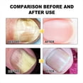 thumbnail image 5 of Láseres para el Tratamiento de Hongos en las Uñas, Limpieza de Dispositivos, Onicomicosis, Reparación Hongos en las Uñas, Eliminación Hongos en las Uñas, Tratamiento Antihongos., 5 of 5