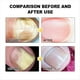 thumbnail image 5 of Láseres para el Tratamiento de Hongos en las Uñas, Limpieza de Dispositivos, Onicomicosis, Reparación Hongos en las Uñas, Eliminación Hongos en las Uñas, Tratamiento Antihongos., 5 of 5