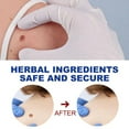 thumbnail image 4 of 1pcs 12 Hours Wart Remover Pen Skin Tag Mole Remover Remove Corn Warts on Feet Unisex, 4 of 5