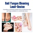 thumbnail image 4 of 1-3pcs Fungal Nail Laser Device Repair Fast Nails Fungus Onychomycosis, 4 of 5