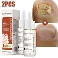 thumbnail image 1 of Suero para el cuidado de las uñas con hongos, loción de esencia para reparación de uñas gruesas y suaves, tratamiento blanqueador de dedos de los pies, 1 of 5