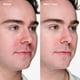 thumbnail image 3 of Gel para tratamiento del acné Clinique Acne Solutions, 10 ml, 3 of 8