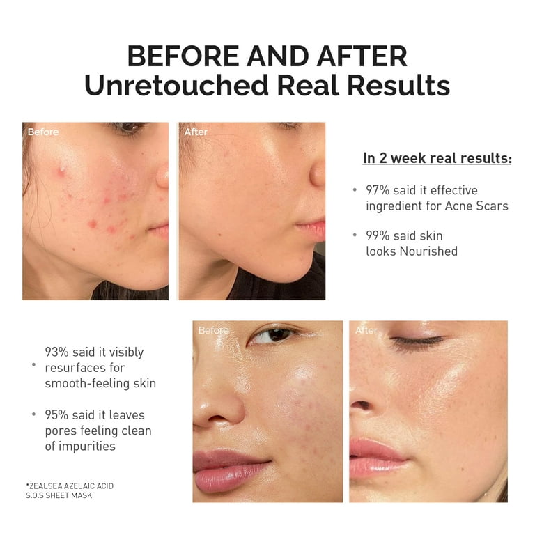 URU BEAUTY facial sheet mask プランエスクリニック ZealSea Azelaic Acid Facial Mask, Acne Treatment, Rosacea