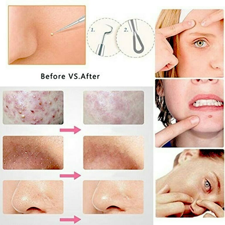Dr pimple popper blackhead removal online
