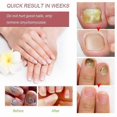 thumbnail image 4 of 2PCS 30/20ml Fungal Nail Repair Liquid Nail Treatments For Thicken Soft Nails Anti Infections, 4 of 5
