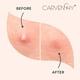 thumbnail image 5 of Facial Acne Patch Hydrocolloid Acne Patch With Tea Oil Witch Hazel Centella Asiatica And Hyaluronic (96 Tablets), 5 of 5