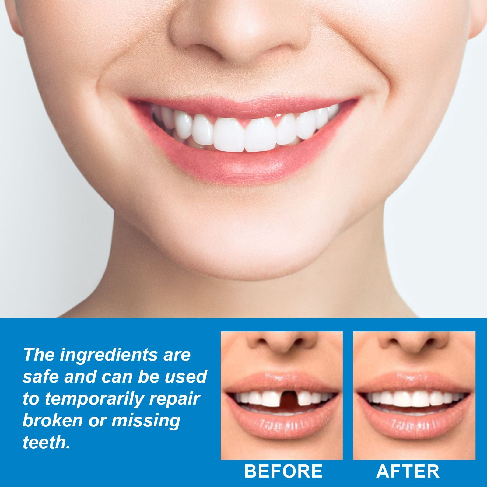 Alvantor Temporary Tooth Replacement Kit, Moldable Dental Filling Cavity Adhesive for Broken or Missing Teeth, 1fl.oz