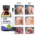thumbnail image 4 of Powerful Nail Fungus Solution - 30ml Toenail Repair Treatment for Stronger, Healthier Nails, 4 of 5
