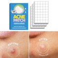 thumbnail image 2 of SharkTRUE Effective Acne Care Patches: Circle, Elliptical & Crescent Shapes, Quick Dry Application, 2 of 8
