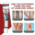 thumbnail image 5 of Crema para tratamiento de venas varicosas, angitis, piernas, alivio dilatado, Vasculitis, flebitis, pierna Araña, Varicosity, medicina para el cuidado de los pies, 5 of 5