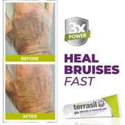 terrasil Bruise Cream with Arnica for Thin Skin Bruises, Senile Purpura Treatment & Skin Bruising, 1.7oz