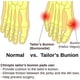 thumbnail image 3 of Bunion Corrector Pad Straightener Separator Cushion Pinky Toe Protector Shield Pain Relief Spacer Splint Cover Guard (1 Pack), 3 of 5