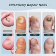 thumbnail image 5 of Portable Nail Fungus Laser Treatment Device - 905nm Infrared & 470nm Blue Dual Light Therapy for Toenails Fingernails, Home Use, 5 of 5