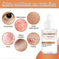 thumbnail image 5 of Éliminateur de Milium - Dissout & Réduit Milium, Whitehead, Hyperplasia Sébacé - 30ml, 5 of 5