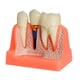thumbnail image 4 of Modelo de implante,Modelo de implante para la educación del paciente,Presentación con puente coronal removible,Práctica de enseñanza con modelo dental 4 veces,Clase de demostración, 4 of 9