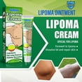 thumbnail image 1 of Sumifun lipomas crema limpieza celulitis grasa bulto eliminación cuerpo cuidado de la piel Ehuebsd cuidado belleza, 1 of 5