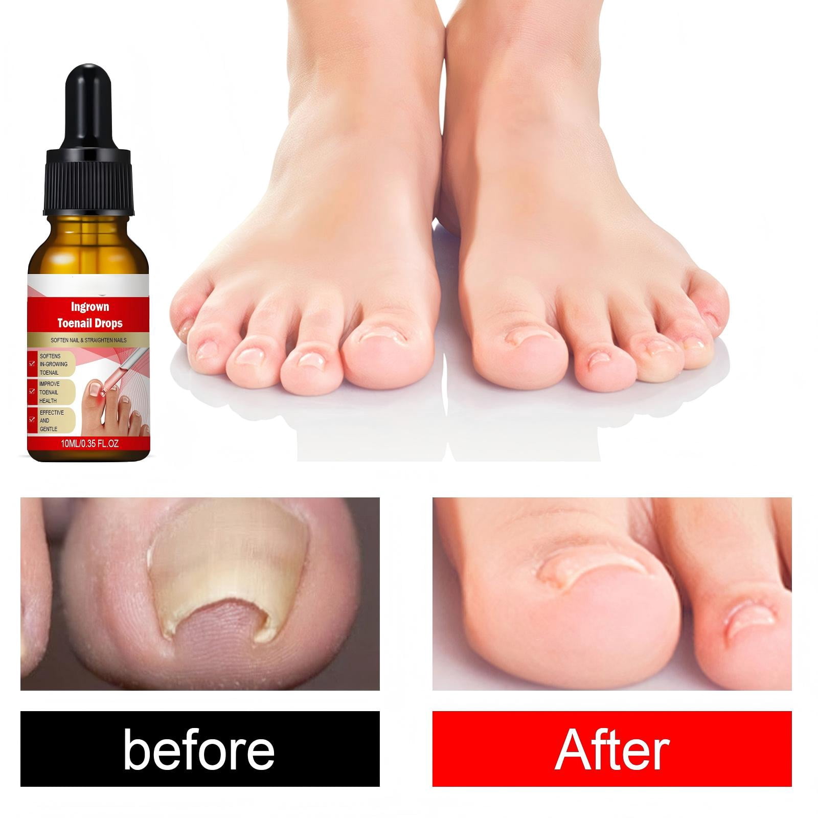 Alvantor Ingrown Toenail Essence Moisturizing Nail Care Oil for Damaged Toenails, 10ml