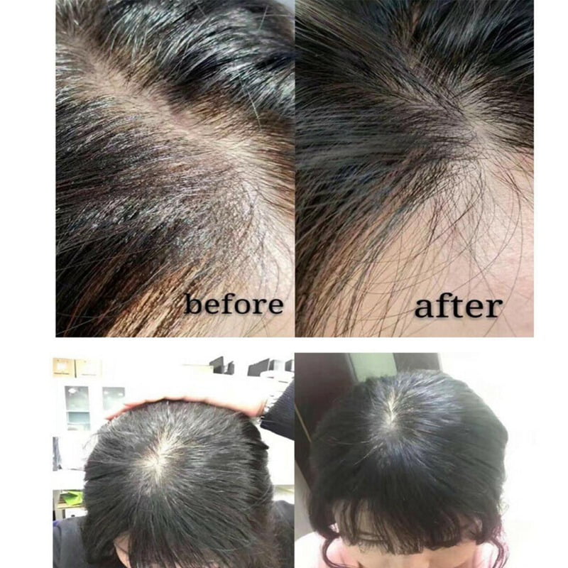 Cheap Hair Growth Shampoo Anti-dandruff Regrowth Fast Growth Hair Serum  Treatments Oil For Anti Hair Fall Loss Care Products Men Women | Joom