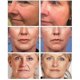 thumbnail image 2 of Retinol Instant Wrinkles Removal Cream 5 Seconds Lifting Firming Anti-aging Improve Puffiness Fade Fine Lines Face Care Products-M, 2 of 5