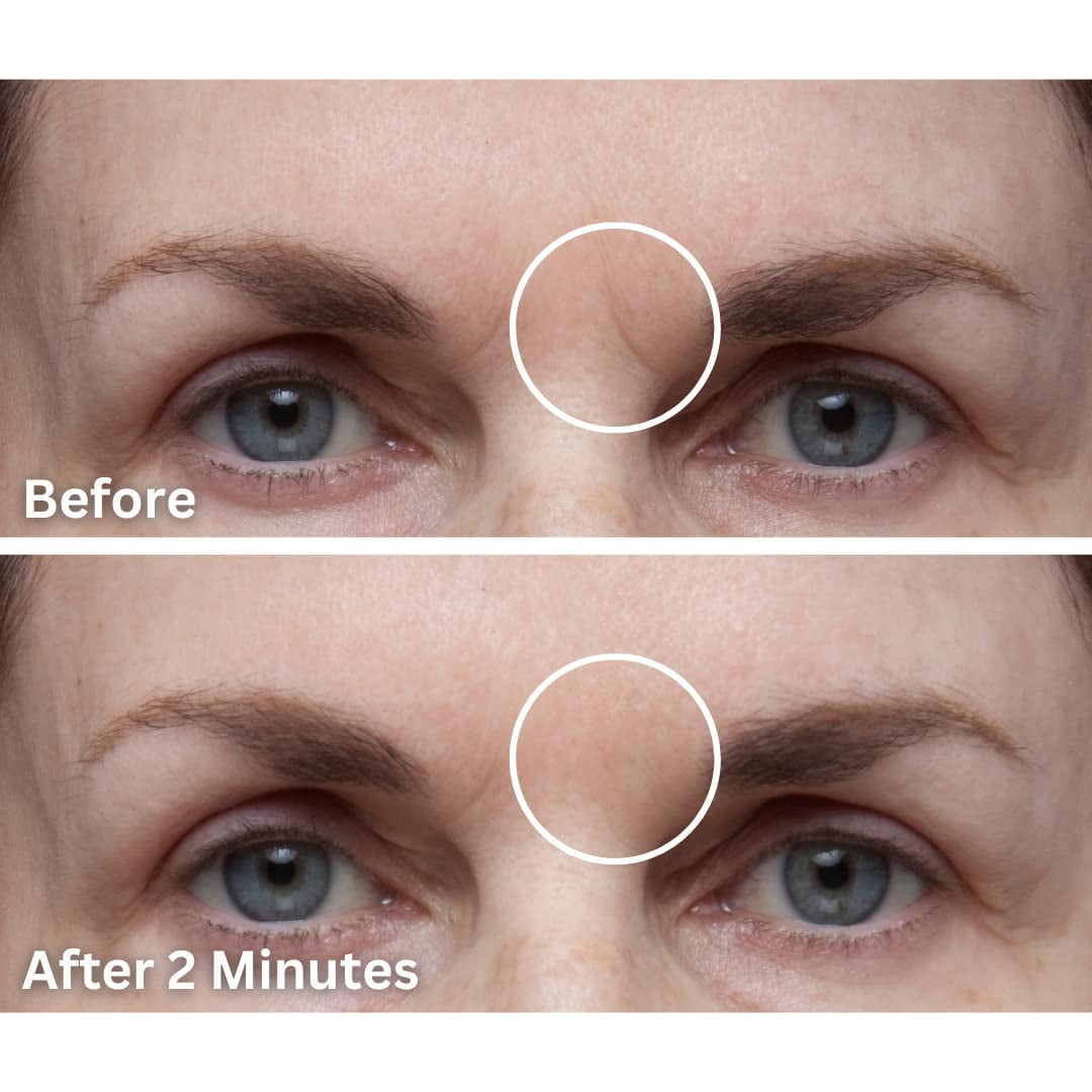 Dermaflage Scar Filler, Acne Scar Filler, Scar Concealer Makeup, 1 Mo Supply - Light