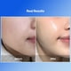 thumbnail image 5 of Mascarilla de hidrogel MEDITHERAPY Bluelayer Water Dome con ácido hialurónico, 5 of 8