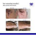 thumbnail image 2 of Rejuvaskin Scar Heal Kit - Scar Kit For Medium Scar - Scar Treatment for Soften, Flatten, Reduce and Recover Scars - Scar Gel, 3" x 5" Silicone Sheet & Medical Tape - Physician Recommended, 2 of 7