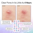 thumbnail image 3 of Parches para espinillas Pore Strip, hidrocoloide Grace & Stella, 72 unidades, 3 of 9